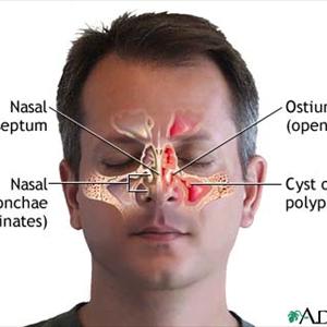 Sinusitis Headaches - Acute Sinusitis Or Swelling In The Sinuses From 7 To 10 Days Can Be Treated With A Sinus Saline Spr