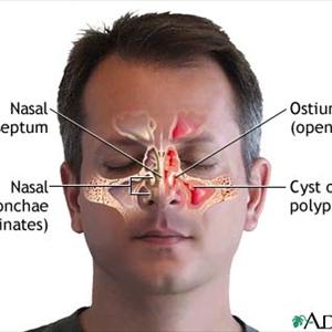 Sinusitis Headaches 