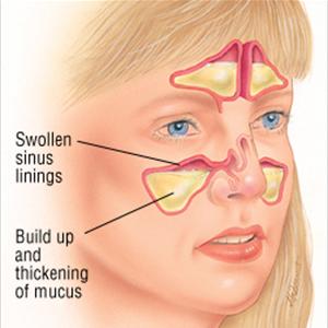 Why Are My Sinuses Burning - Hidden Causes Of Chronic Sinusitis