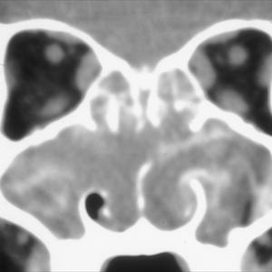 Blocked Frontal Sinus Cavity 