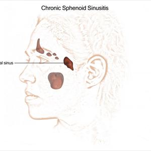 Sinusitis And Crackling Sinuses 