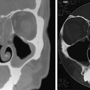 Colloidal Silver Sinus Problems 