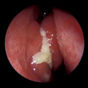 Natural Remedy For Sinus Mucocele 