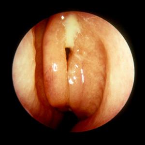 Sinus Nasal Irrigation 