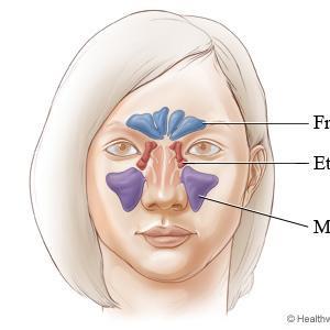  Say Bye To Sinusitis Along With Balloon Sinuplasty