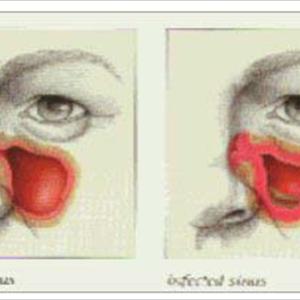 Red Wine Sinus Infection - Fungal Sinusitis: 2 Guaranteed Medical Coding Formulas That Work