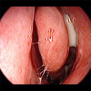 Sphenoid Sinus Infection Steroid 