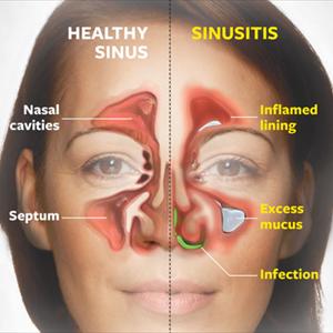 Sinusitis Home Remedy - Sinus Infection Sufferers Can Treat It With Great, Natural, Home Remedies.