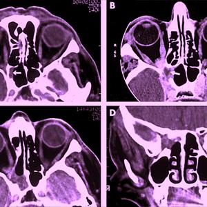 Treatment Sinusitis - How The Nose Affects Sinusitis