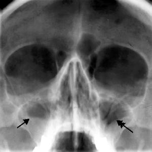 Sinus Cavity Diagram - Deviated Nasal Septum: More Than Mere Appearances