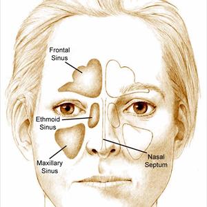 Bad Smelling Sinus Infection - Hearing Loss Ringing Ears - Ringing Ears May Be Sinus Related