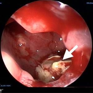  A Guide To Sinusitis Treatment