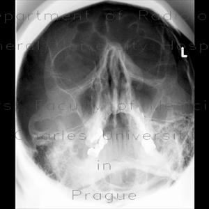 Amino Acids For Sinus Infections - Say Bye To Sinusitis Along With Balloon Sinuplasty