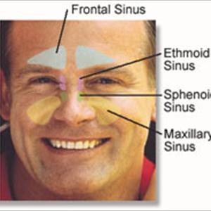Sinuvil Medication - A Comprehensive Guide To Sphenoid Sinus