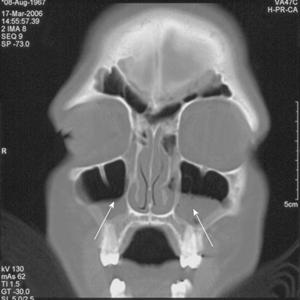 Dry Sinuses 