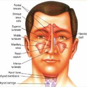 Sinusitis Natural Remedies - Sinus Headache Remedies