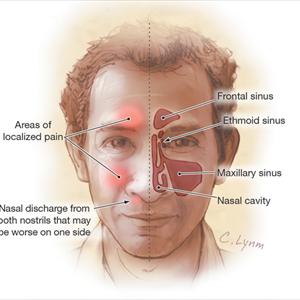 Sinusitis-Natural Remedy - When Chronic Sinusitis Attacks