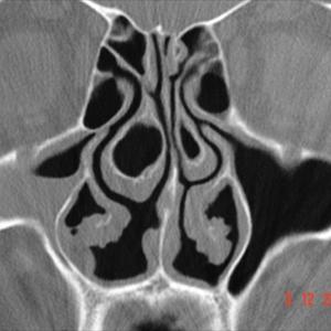 Stiff Jaw After Infection - Balloon Sinuplasty- A Perfect Solution To Chronic Sinus Problems