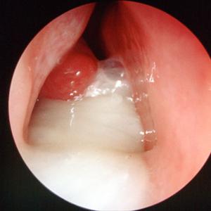 Constant Congestion - Sinusitis Remedies