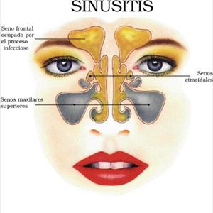 Home Remedies For Sinus 