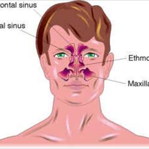 Fight Sinus Infection - Sinus Infection - Causes And Precautions