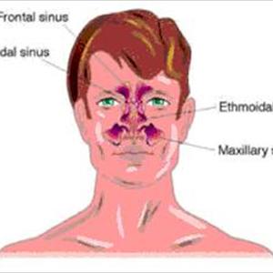 Where Can I Buy Sinuvil - Try Balloon Sinuplasty For Effective Sinus Treatment